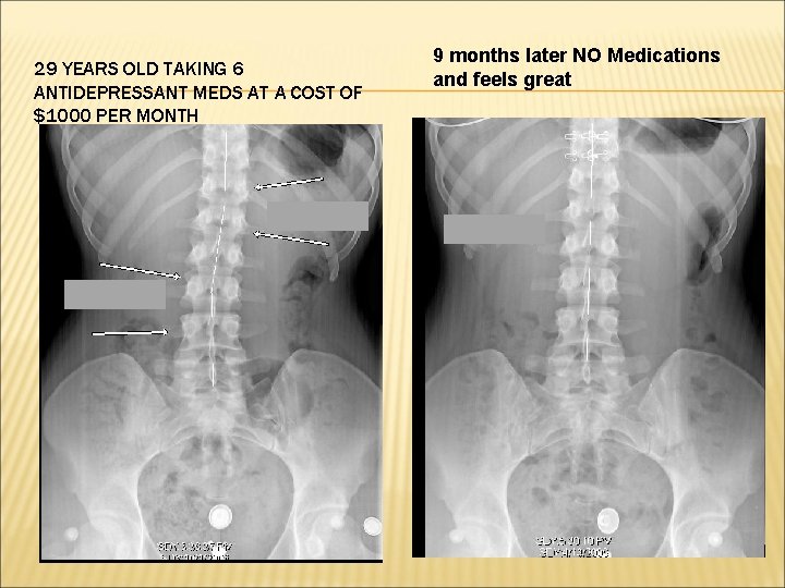 29 YEARS OLD TAKING 6 ANTIDEPRESSANT MEDS AT A COST OF $1000 PER MONTH