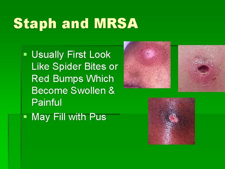 Staph and MRSA § Usually First Look Like Spider Bites or Red Bumps Which