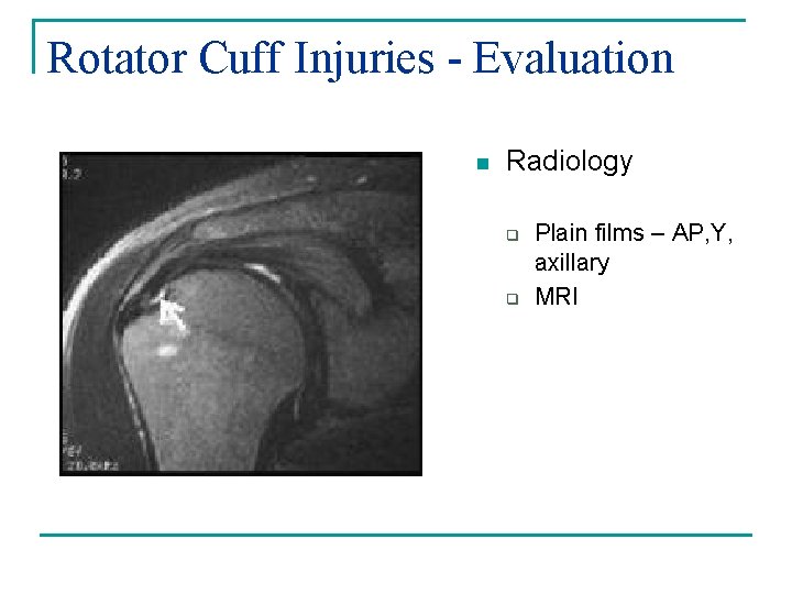 Rotator Cuff Injuries - Evaluation n Radiology q q Plain films – AP, Y,
