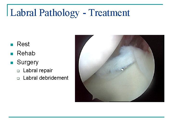 Labral Pathology - Treatment n n n Rest Rehab Surgery q q Labral repair