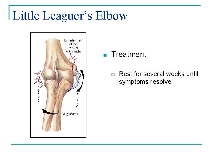 Little Leaguer’s Elbow n Treatment q Rest for several weeks until symptoms resolve 