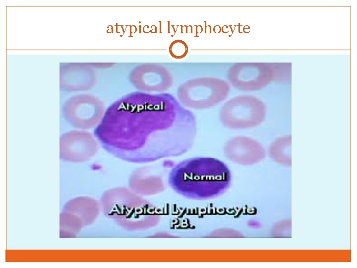 atypical lymphocyte 