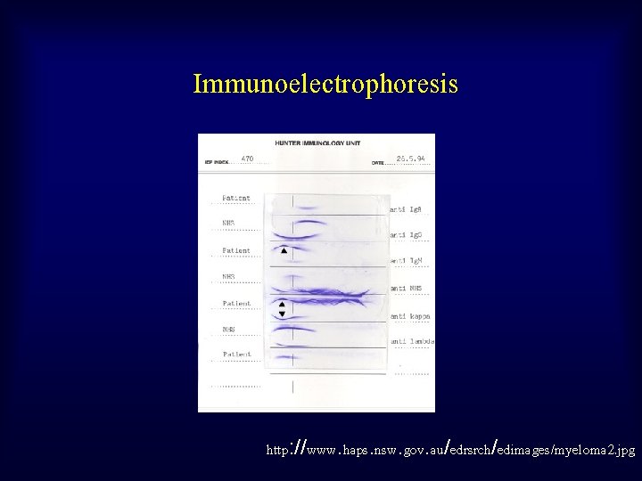 Immunoelectrophoresis http: //www. haps. nsw. gov. au/edrsrch/edimages/myeloma 2. jpg 