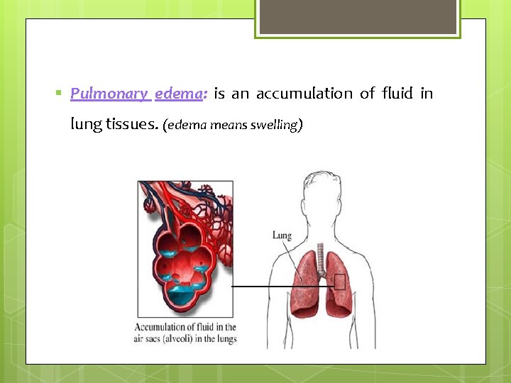 § Pulmonary edema: is an accumulation of fluid in lung tissues. (edema means swelling)