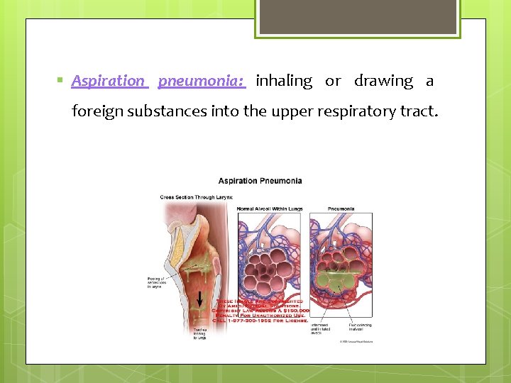§ Aspiration pneumonia: inhaling or drawing a foreign substances into the upper respiratory tract.