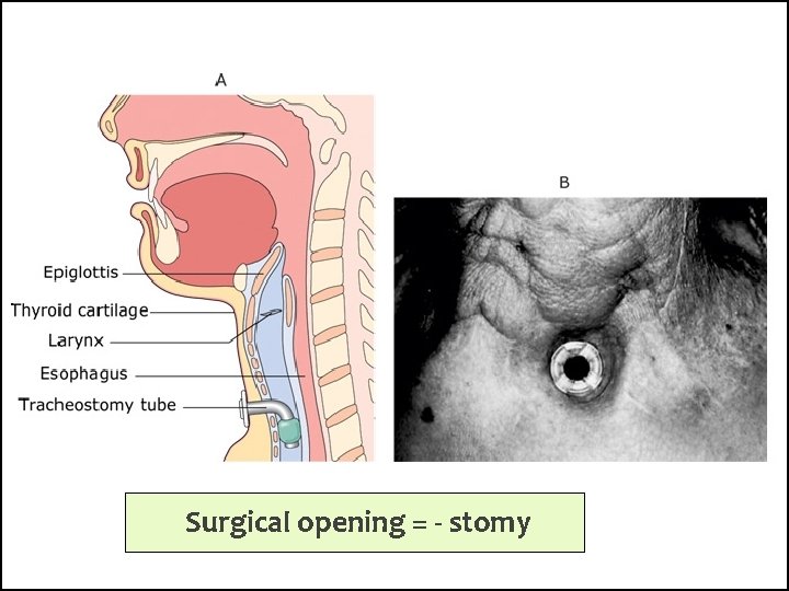 Surgical opening = - stomy 