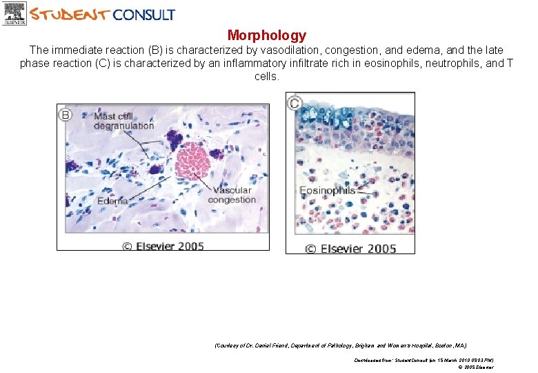 Morphology The immediate reaction (B) is characterized by vasodilation, congestion, and edema, and the