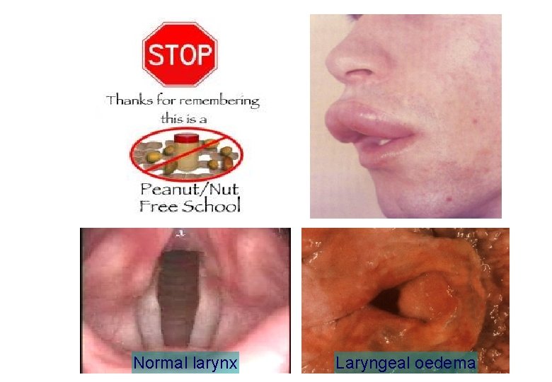 Normal larynx Laryngeal oedema 