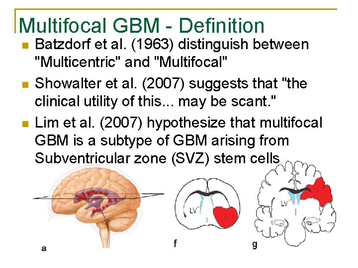 Multifocal GBM - Definition n Batzdorf et al. (1963) distinguish between "Multicentric" and "Multifocal"