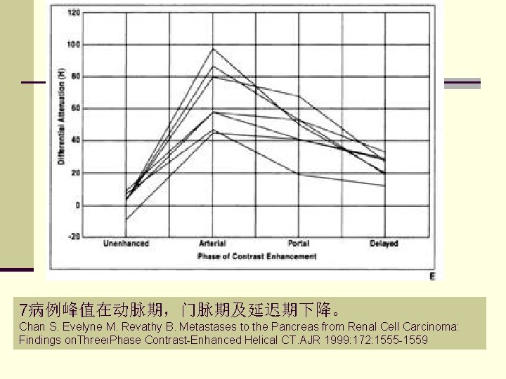 7病例峰值在动脉期，门脉期及延迟期下降。 Chan S. Evelyne M. Revathy B. Metastases to the Pancreas from Renal Cell