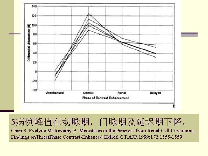 5病例峰值在动脉期，门脉期及延迟期下降。 Chan S. Evelyne M. Revathy B. Metastases to the Pancreas from Renal Cell