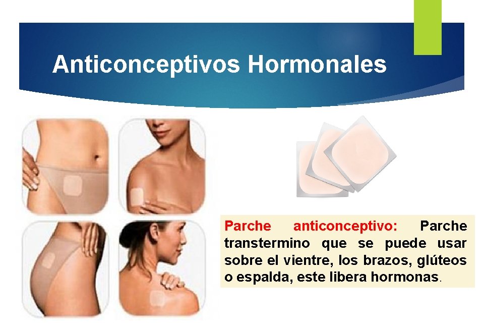 Anticonceptivos Hormonales Parche anticonceptivo: Parche transtermino que se puede usar sobre el vientre, los