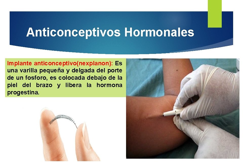 Anticonceptivos Hormonales Implante anticonceptivo(nexplanon): Es una varilla pequeña y delgada del porte de un