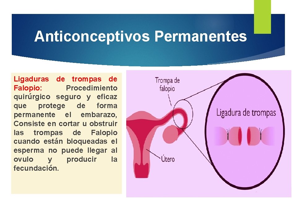 Anticonceptivos Permanentes Ligaduras de trompas de Falopio: Procedimiento quirúrgico seguro y eficaz que protege