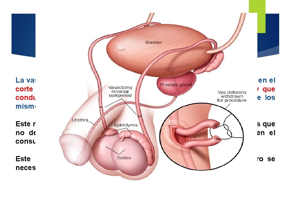 Vasectomía La vasectomía es un método anticonceptivo masculino que consiste en el corte del