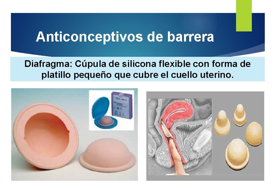 Anticonceptivos de barrera Diafragma: Cúpula de silicona flexible con forma de platillo pequeño que