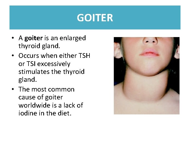 GOITER • A goiter is an enlarged thyroid gland. • Occurs when either TSH