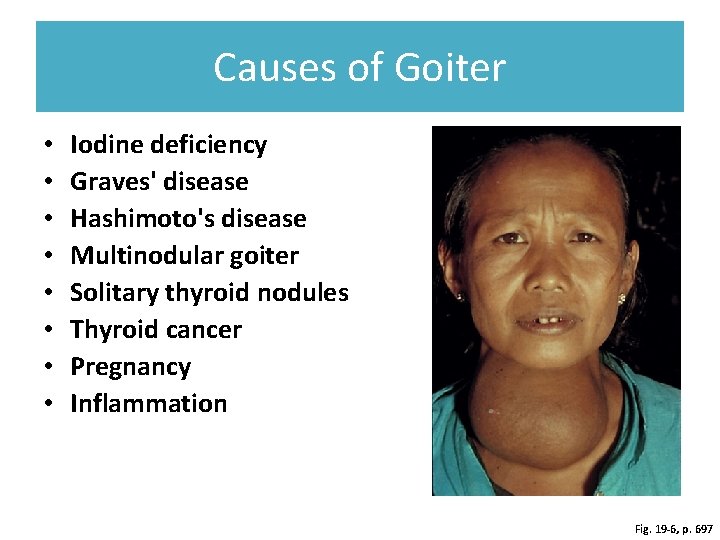 Causes of Goiter • • Iodine deficiency Graves' disease Hashimoto's disease Multinodular goiter Solitary