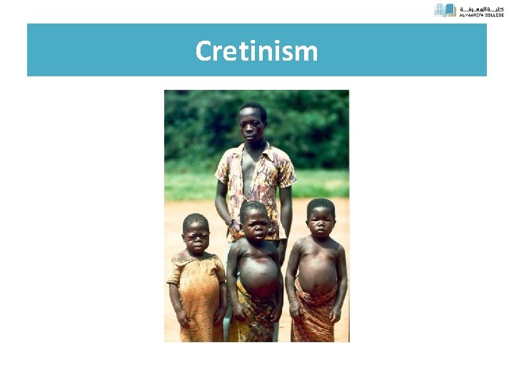 Cretinism 