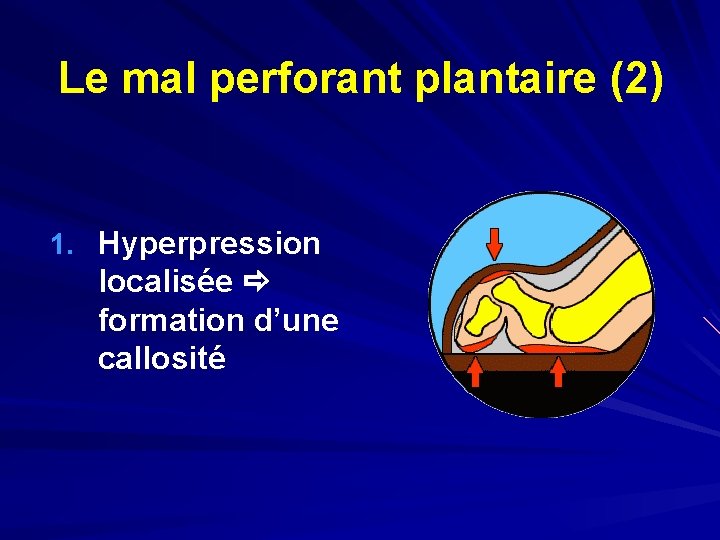 Le mal perforant plantaire (2) 1. Hyperpression localisée formation d’une callosité 