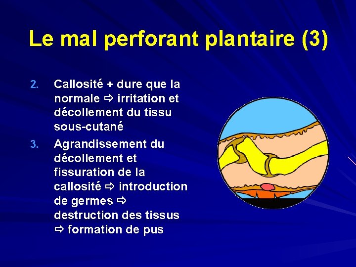 Le mal perforant plantaire (3) 2. 3. Callosité + dure que la normale irritation