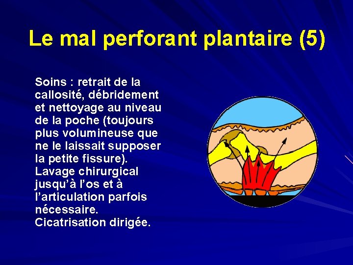 Le mal perforant plantaire (5) Soins : retrait de la callosité, débridement et nettoyage