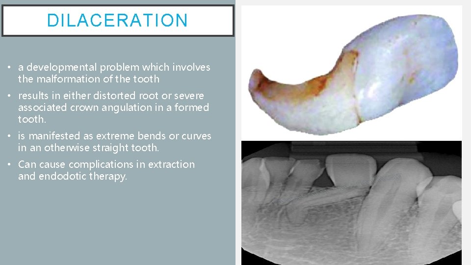DILACERATION • a developmental problem which involves the malformation of the tooth • results
