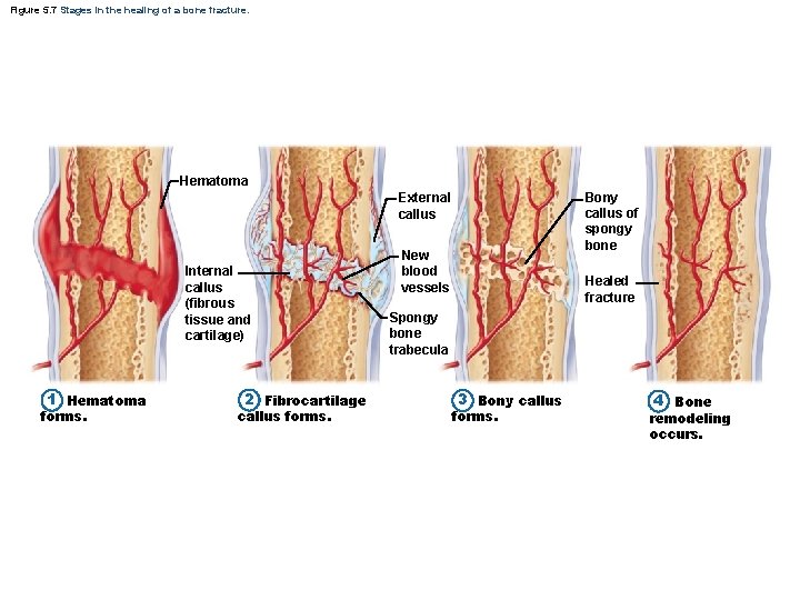 Figure 5. 7 Stages in the healing of a bone fracture. Hematoma Bony callus