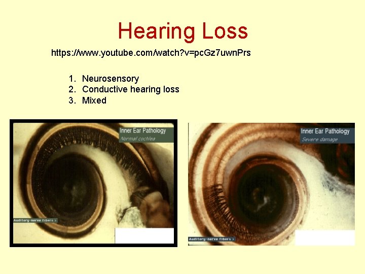Hearing Loss https: //www. youtube. com/watch? v=pc. Gz 7 uwn. Prs 1. Neurosensory 2.