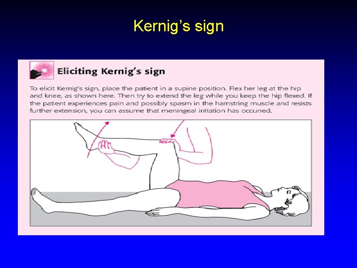Kernig’s sign 