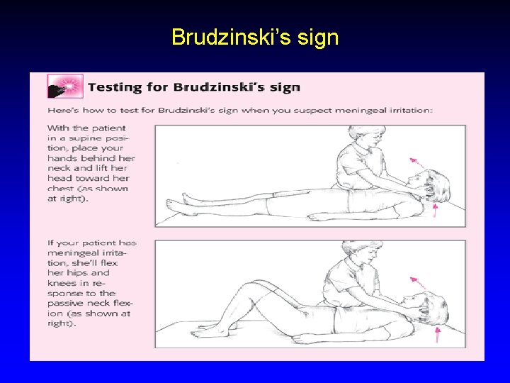 Brudzinski’s sign 