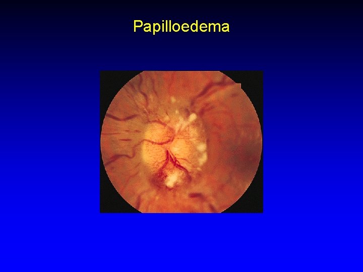 Papilloedema 