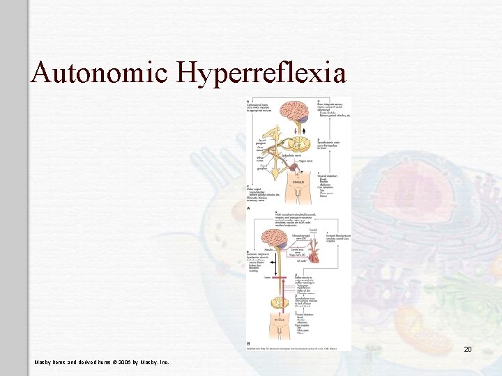 Autonomic Hyperreflexia 20 Mosby items and derived items © 2006 by Mosby, Inc. 