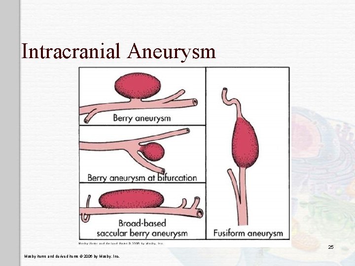 Intracranial Aneurysm 25 Mosby items and derived items © 2006 by Mosby, Inc. 