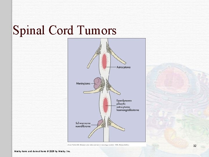 Spinal Cord Tumors 32 Mosby items and derived items © 2006 by Mosby, Inc.