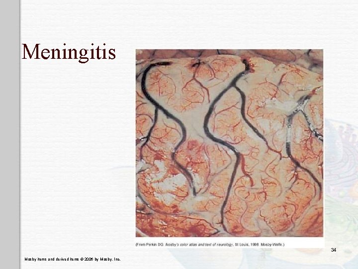 Meningitis 34 Mosby items and derived items © 2006 by Mosby, Inc. 