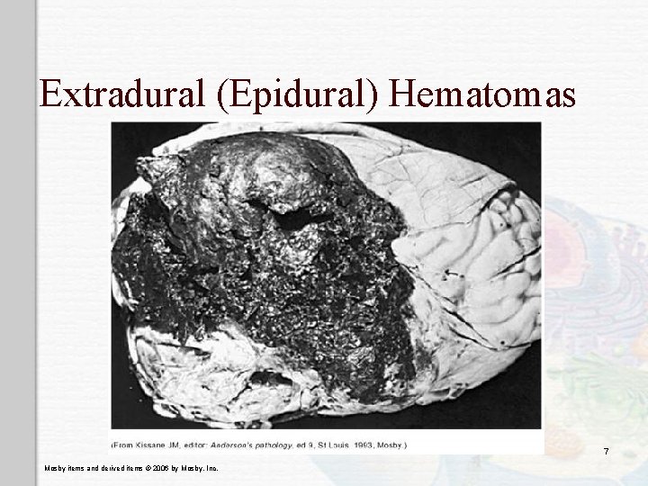 Extradural (Epidural) Hematomas 7 Mosby items and derived items © 2006 by Mosby, Inc.