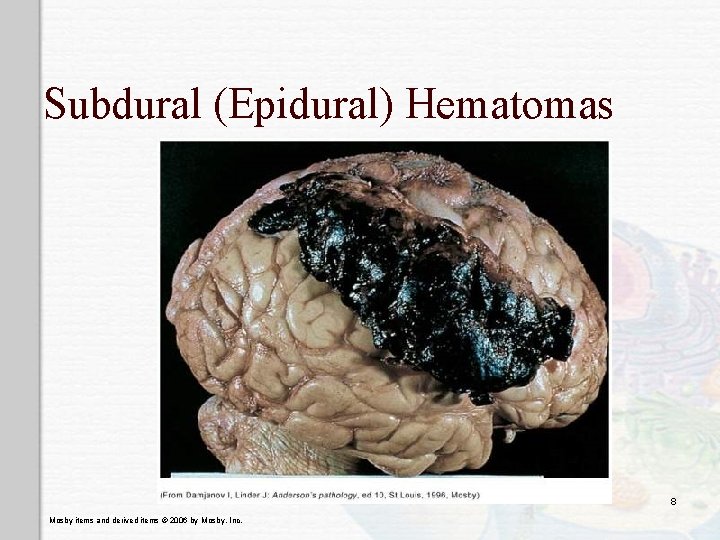 Subdural (Epidural) Hematomas 8 Mosby items and derived items © 2006 by Mosby, Inc.