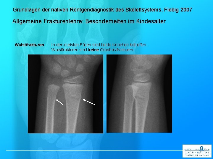 Grundlagen der nativen Röntgendiagnostik des Skelettsystems, Fiebig 2007 Allgemeine Frakturenlehre: Besonderheiten im Kindesalter Wulstfrakturen