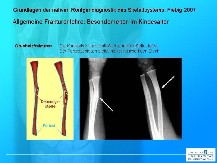 Grundlagen der nativen Röntgendiagnostik des Skelettsystems, Fiebig 2007 Allgemeine Frakturenlehre: Besonderheiten im Kindesalter Grünholzfrakturen