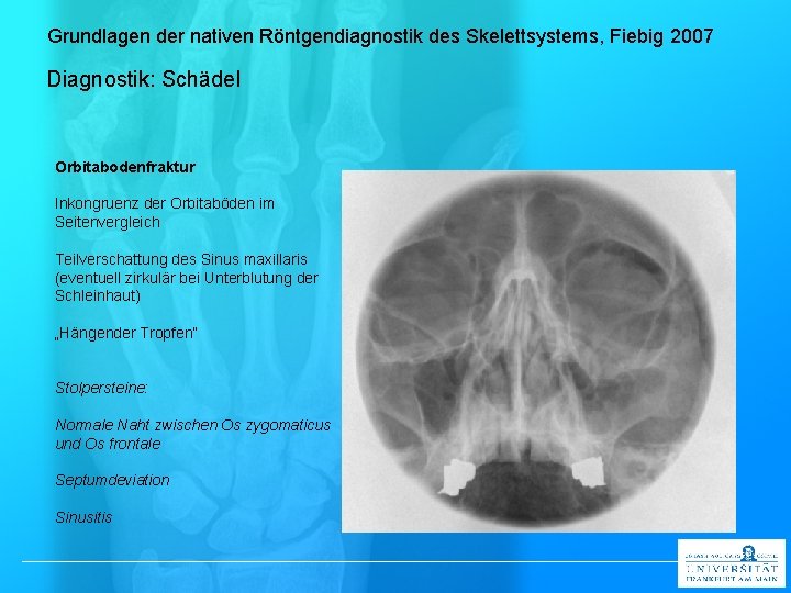 Grundlagen der nativen Röntgendiagnostik des Skelettsystems, Fiebig 2007 Diagnostik: Schädel Orbitabodenfraktur Inkongruenz der Orbitaböden