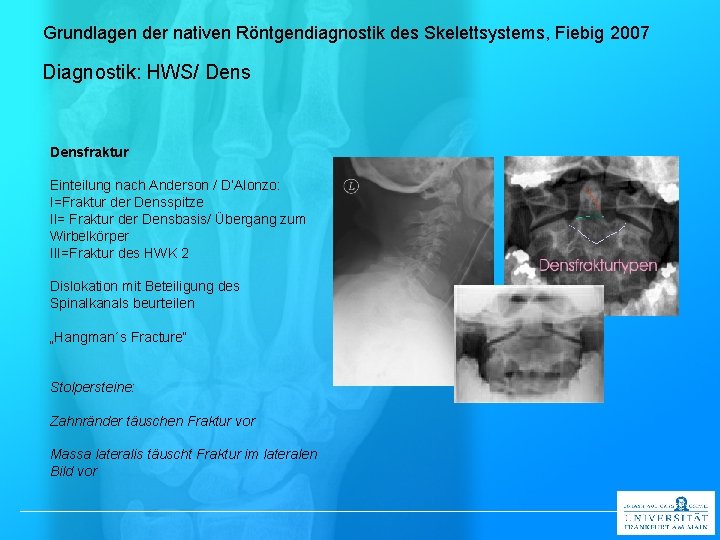 Grundlagen der nativen Röntgendiagnostik des Skelettsystems, Fiebig 2007 Diagnostik: HWS/ Densfraktur Einteilung nach Anderson