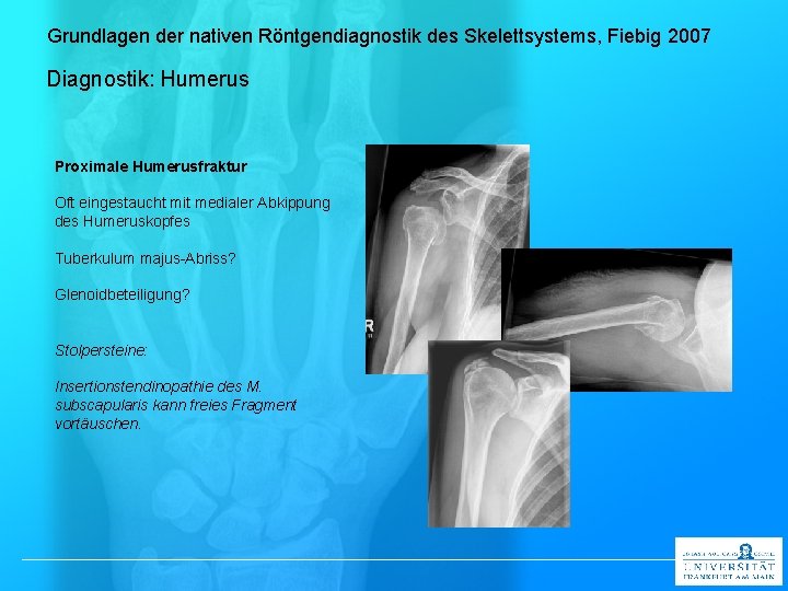 Grundlagen der nativen Röntgendiagnostik des Skelettsystems, Fiebig 2007 Diagnostik: Humerus Proximale Humerusfraktur Oft eingestaucht