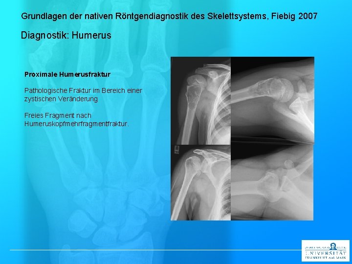 Grundlagen der nativen Röntgendiagnostik des Skelettsystems, Fiebig 2007 Diagnostik: Humerus Proximale Humerusfraktur Pathologische Fraktur