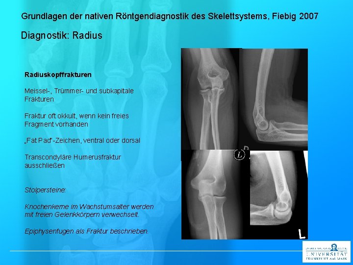 Grundlagen der nativen Röntgendiagnostik des Skelettsystems, Fiebig 2007 Diagnostik: Radiuskopffrakturen Meissel-, Trümmer- und subkapitale