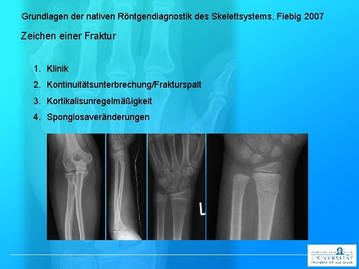 Grundlagen der nativen Röntgendiagnostik des Skelettsystems, Fiebig 2007 Zeichen einer Fraktur 1. Klinik 2.