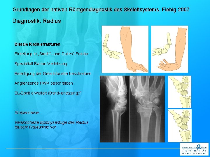 Grundlagen der nativen Röntgendiagnostik des Skelettsystems, Fiebig 2007 Diagnostik: Radius Distale Radiusfrakturen Einteilung in