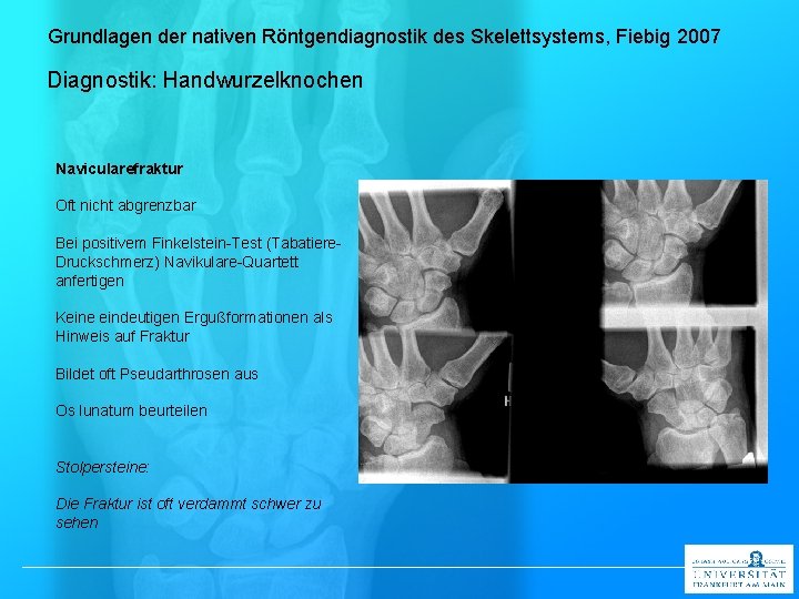 Grundlagen der nativen Röntgendiagnostik des Skelettsystems, Fiebig 2007 Diagnostik: Handwurzelknochen Navicularefraktur Oft nicht abgrenzbar