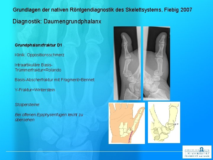 Grundlagen der nativen Röntgendiagnostik des Skelettsystems, Fiebig 2007 Diagnostik: Daumengrundphalanx Grundphalanxfraktur D 1 Klinik: