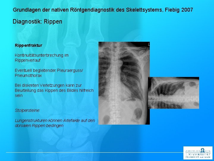 Grundlagen der nativen Röntgendiagnostik des Skelettsystems, Fiebig 2007 Diagnostik: Rippenfraktur Kontinuitätsunterbrechung im Rippenverlauf Eventuell